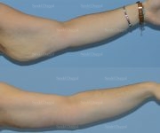 brachioplasty before and after