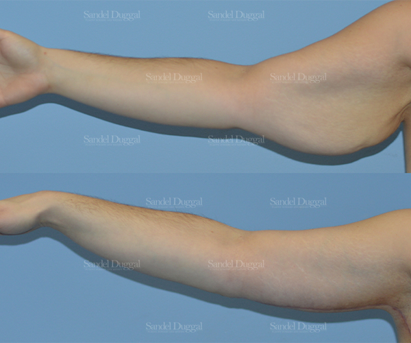 brachioplasty before and after