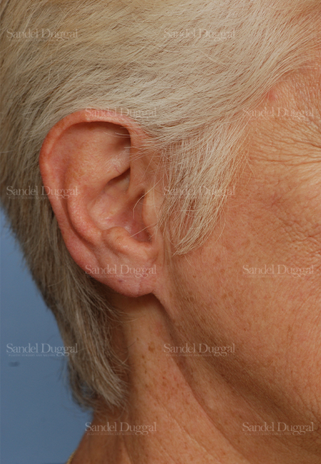 earlobe repair patient