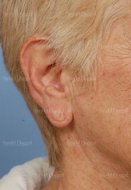 mini facelift patient