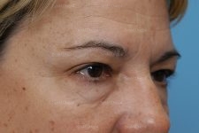 eyelid rejuvenation patient