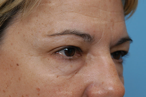 eyelid rejuvenation patient