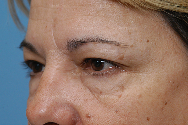 eyelid rejuvenation patient