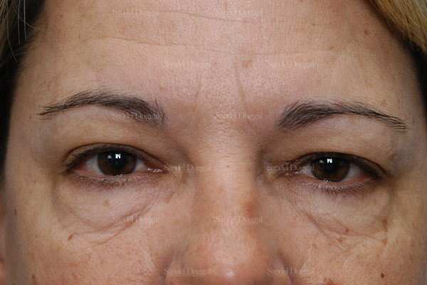 eyelid rejuvenation patient