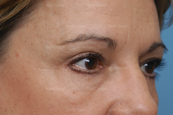 eyelid rejuvenation patient