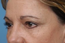 eyelid rejuvenation patient