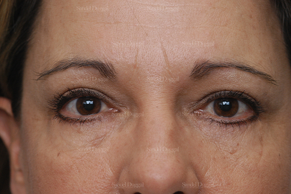 eyelid rejuvenation patient