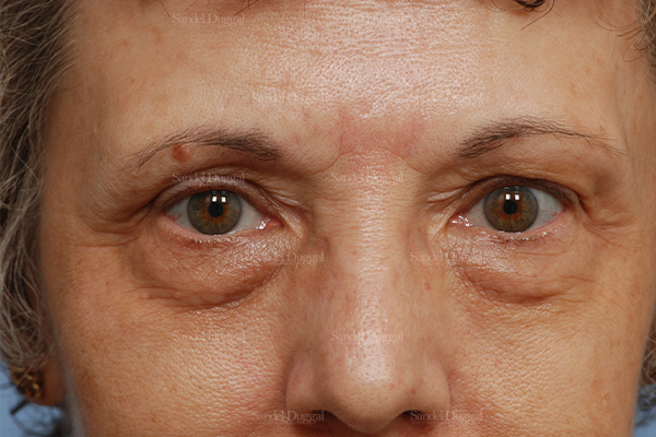 eyelid rejuvenation patient