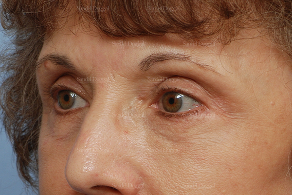 eyelid rejuvenation patient