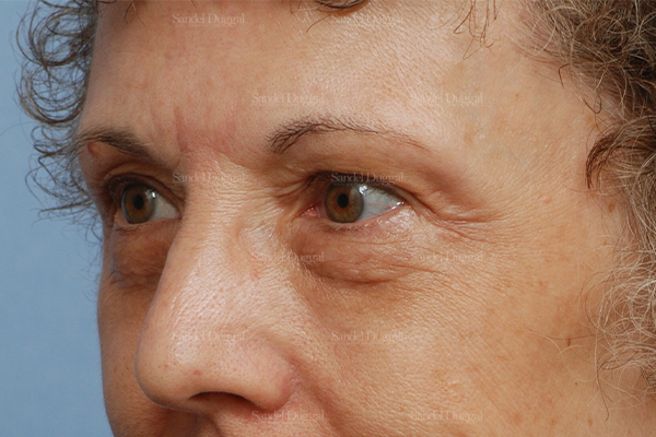 eyelid rejuvenation patient