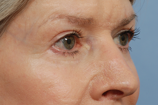 eyelid rejuvenation patient