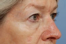 eyelid rejuvenation patient