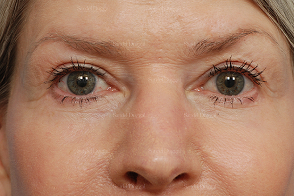 eyelid rejuvenation patient