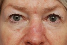 eyelid rejuvenation patient