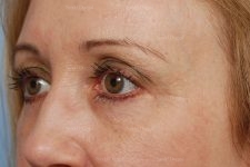 eyelid rejuvenation patient