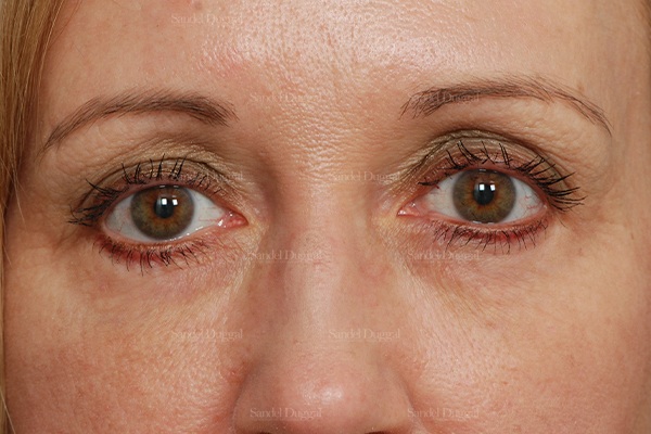 eyelid rejuvenation patient