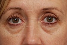 eyelid rejuvenation patient