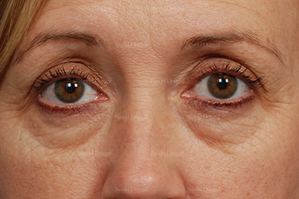 eyelid rejuvenation patient