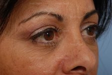 eyelid rejuvenation patient
