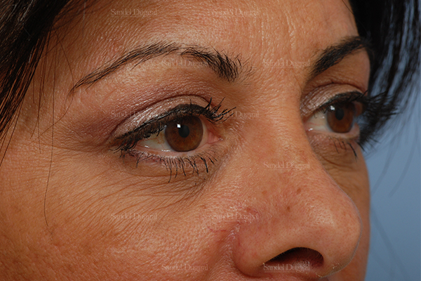 eyelid rejuvenation patient
