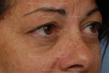 eyelid rejuvenation patient