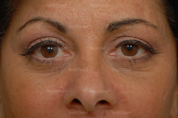 eyelid rejuvenation patient