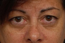 eyelid rejuvenation patient