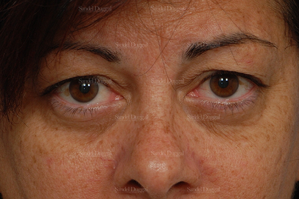 eyelid rejuvenation patient