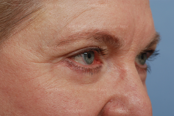 eyelid rejuvenation patient
