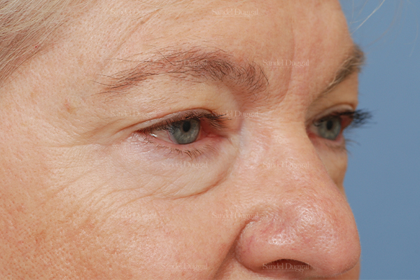 eyelid rejuvenation patient
