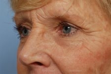 eyelid rejuvenation patient