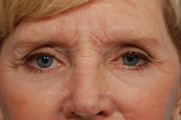 eyelid rejuvenation patient