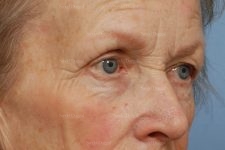 eyelid rejuvenation patient