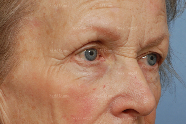 eyelid rejuvenation patient