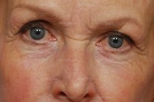 eyelid rejuvenation patient