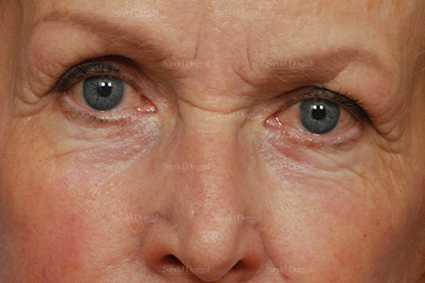 eyelid rejuvenation patient