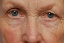eyelid rejuvenation patient