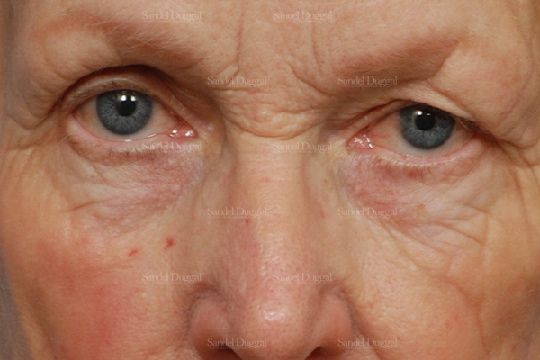 eyelid rejuvenation patient