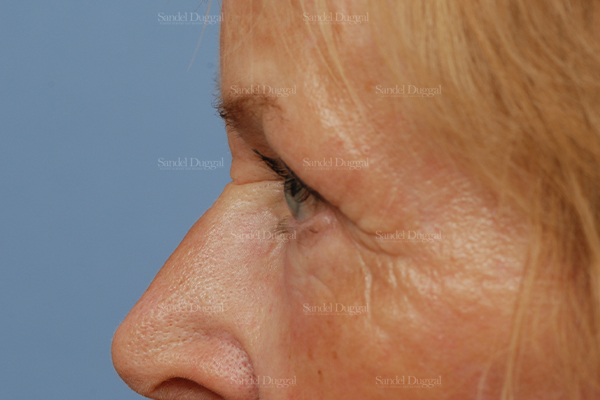 eyelid rejuvenation patient