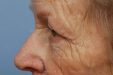 eyelid rejuvenation patient