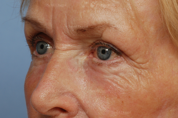 eyelid rejuvenation patient
