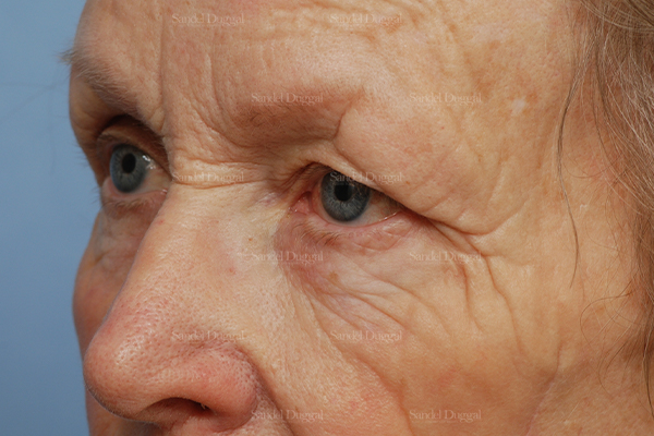 eyelid rejuvenation patient
