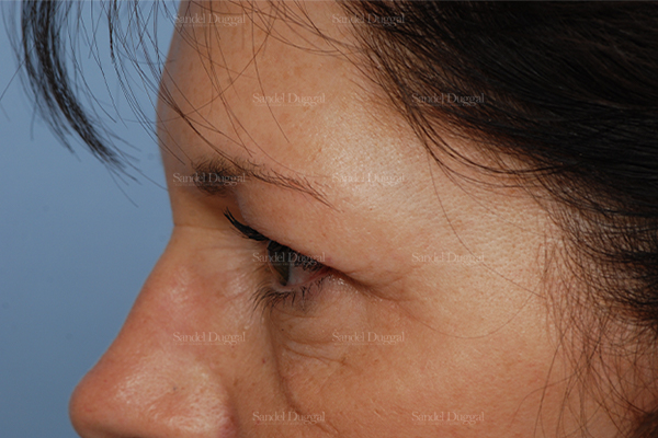eyelid rejuvenation patient