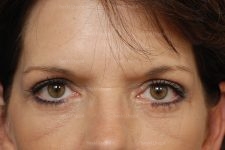 eyelid rejuvenation patient