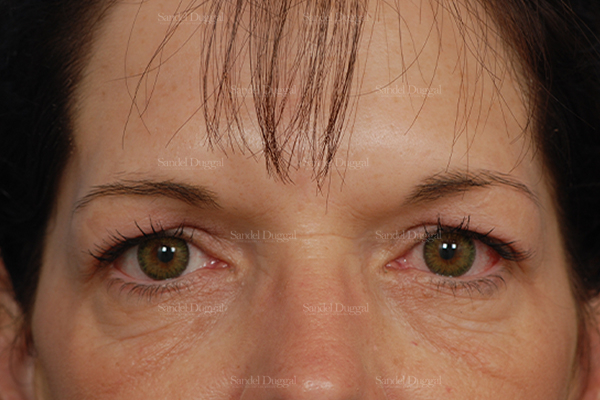 eyelid rejuvenation patient