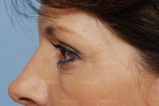 eyelid rejuvenation patient