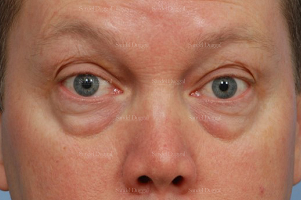 eyelid rejuvenation patient