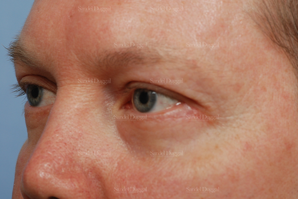 eyelid rejuvenation patient