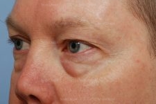 eyelid rejuvenation patient