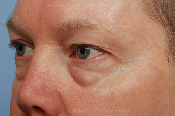 eyelid rejuvenation patient